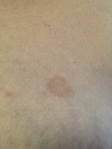Pityriasis Rosea in pregnancy - help!