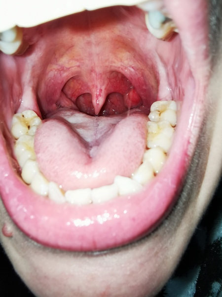 Is this a tonsil cyst? Lump on tonsil