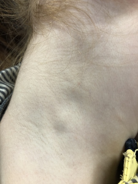 Glands picture my dh says im crazy!