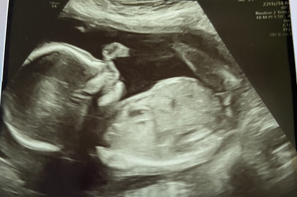 Due March / April 2022 2nd thread 2nd trimester