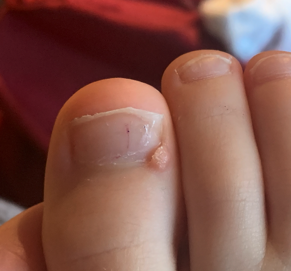 Growth on top of nail (pic attached)
