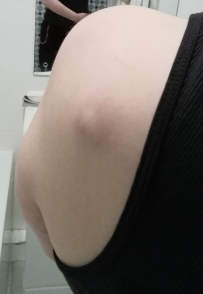 Sebacious Cyst - is it supposed to hurt this much?