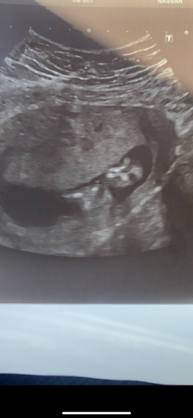 Baby scan pic