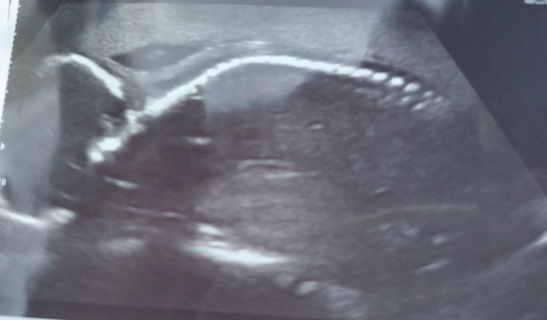 Due March / April 2022 2nd thread 2nd trimester