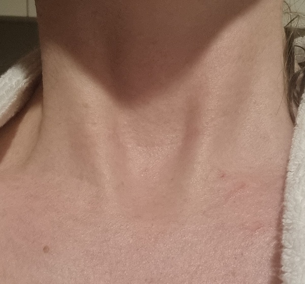 To ask has anyone had a thyroidectomy? I'm so scared!!