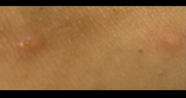 Could this be chickenpox?
