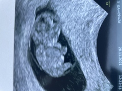 Any ivf pregnancies ?