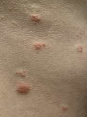 Does this look like the shingles rash?