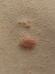 Does this look like the shingles rash?