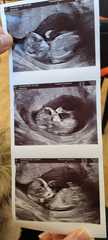 12 week scan anxiety