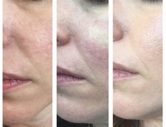 I’ve had a thread lift