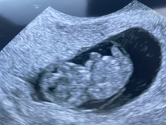 Any ivf pregnancies ?