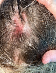 Infected skin not clearing up!