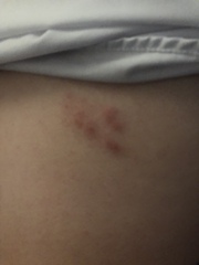 Shingles?