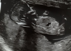 Confused about 12 week scan