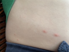 Are these chicken pox?