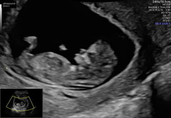 Nub theory 11 weeks ?!