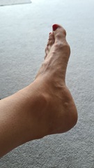 Achilles issues