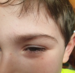 Purple radish mark on childs face