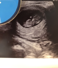 Confused about 12 week scan