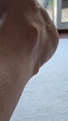 Achilles issues