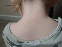 Would you use steroid eczema on this patch of  eczema?