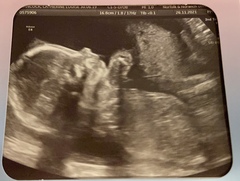 Due March / April 2022 2nd thread 2nd trimester