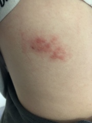 Shingles?