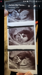 12 week scan anxiety