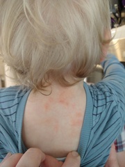 Would you use steroid eczema on this patch of  eczema?