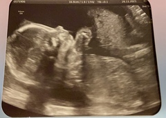 Due March / April 2022 2nd thread 2nd trimester