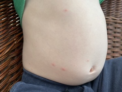 Are these chicken pox?