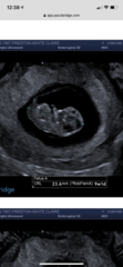 Confused about 12 week scan