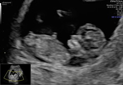 Nub theory 11 weeks ?!
