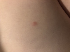 Are these bites on my dd? Going crazy over it!