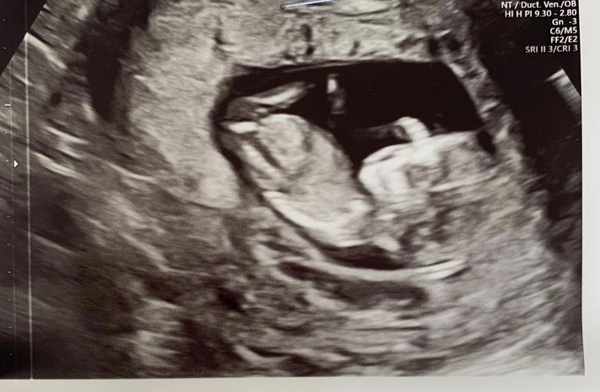 Nub/skull guesses girl or boy?
