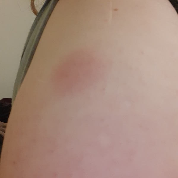Swollen arm after booster vaccine