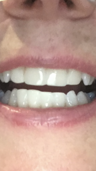Dental veneers?