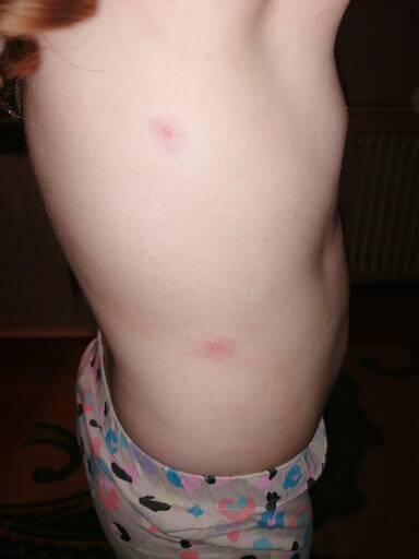 Red welts, now a head