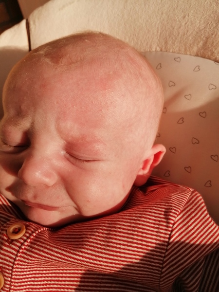 Is this a cmpa rash?