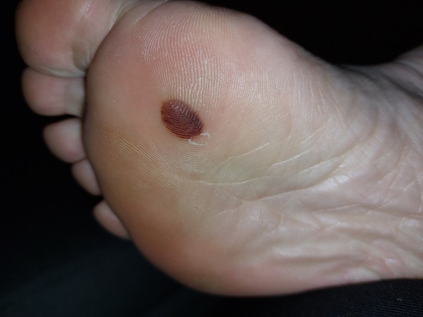 Do GPs actually examine suspicious moles?
