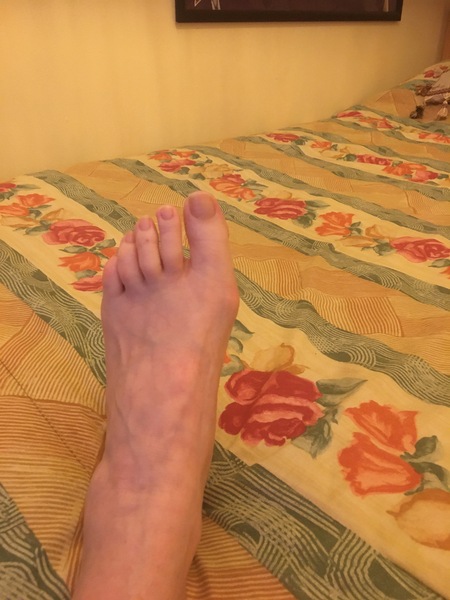 To fucking HATE bunions