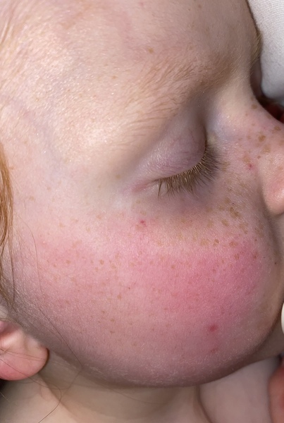 Red blood spots 4 year old