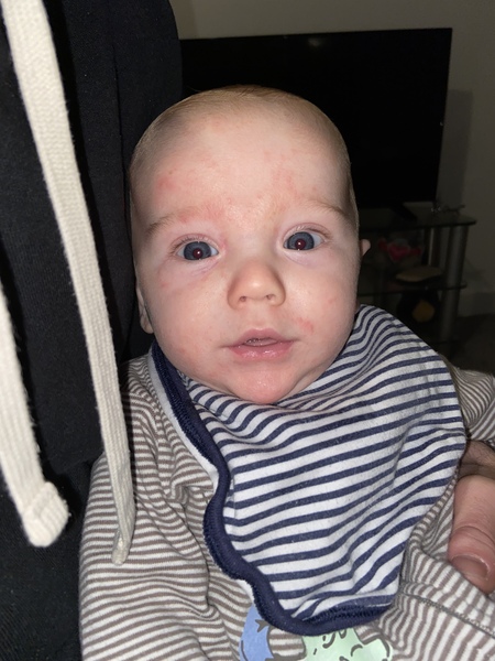 CMPA? Eczema? EBF