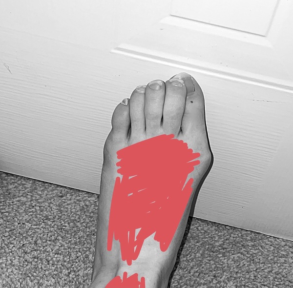 To fucking HATE bunions