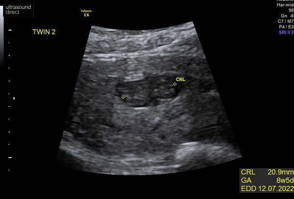 Pregnancy after miscarriage