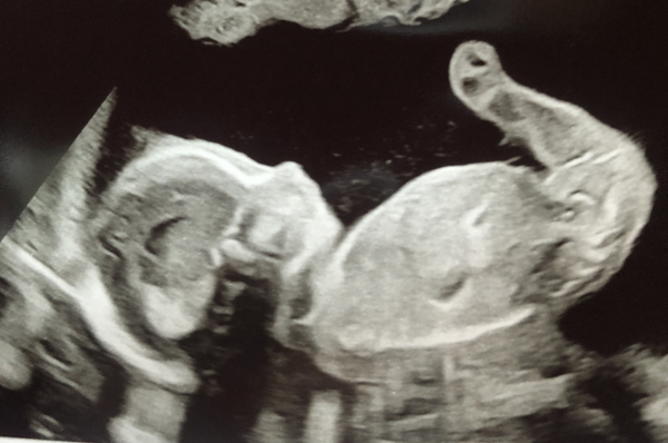 Boy or Girl? 20 week scan - just for fun!