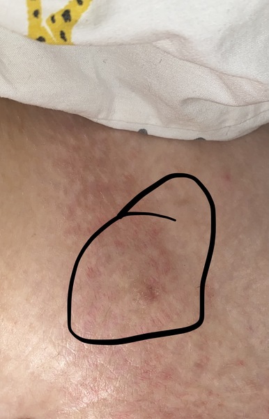 Disappearing mole on hip? Hip pain now..