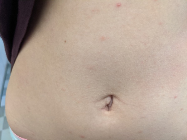 Rash on Teen