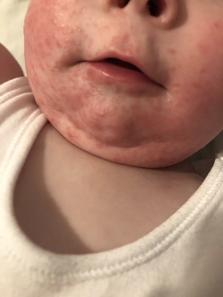 Rash